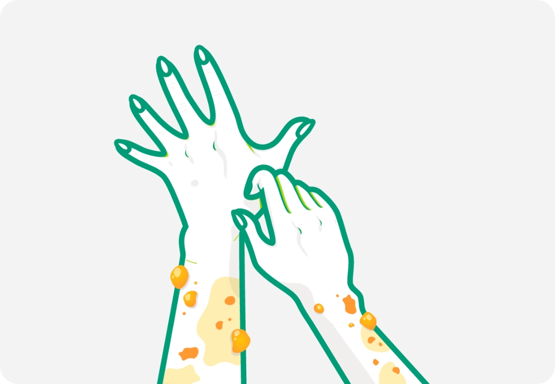 Illustration of two hands with nodules representing prurigo nodularis. 