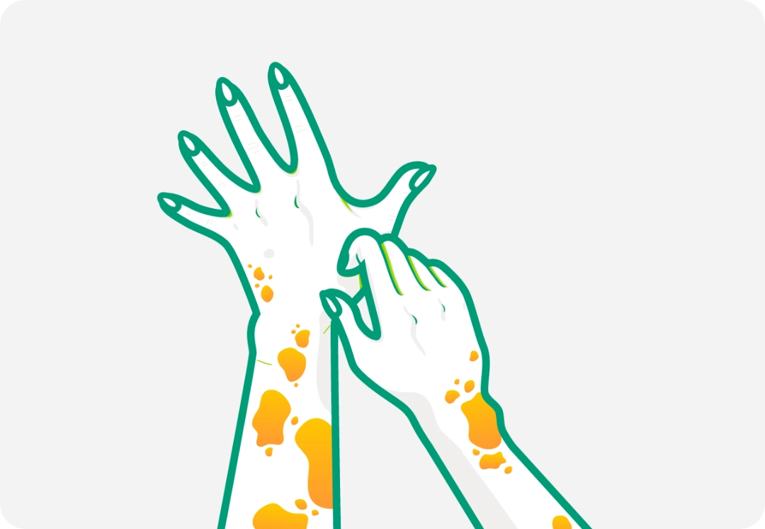 Illustration of two hands with nodules representing prurigo nodularis. 