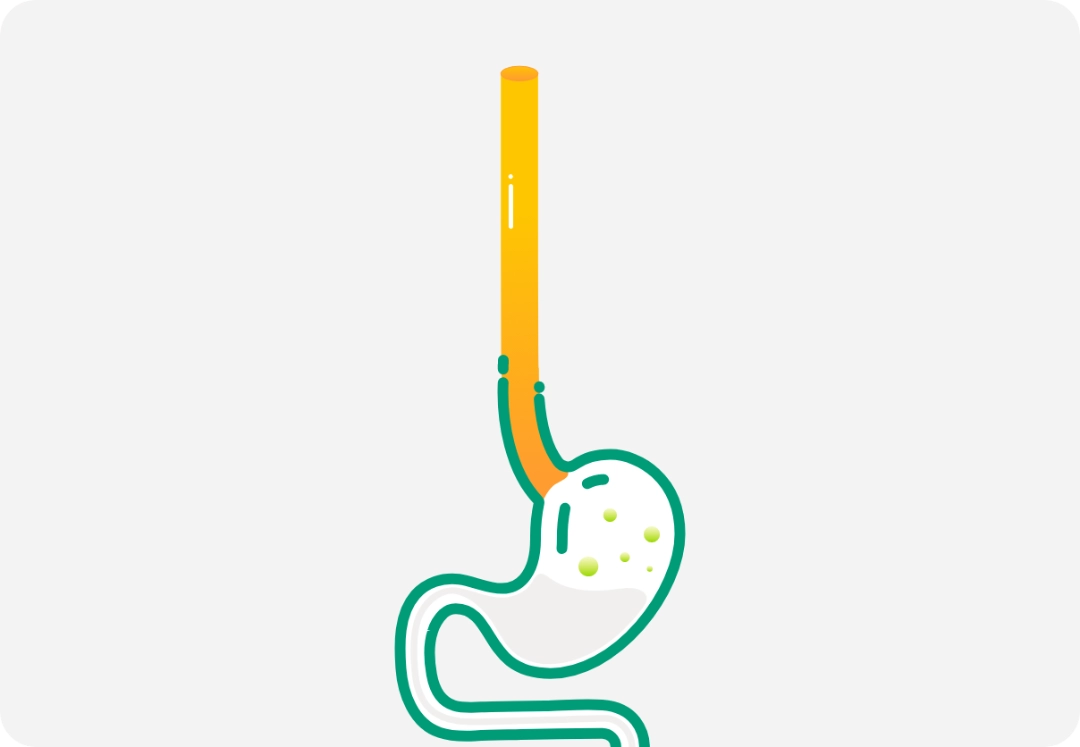Illustration of a human digestive track to stomach representing eosinophilic esophagitis.