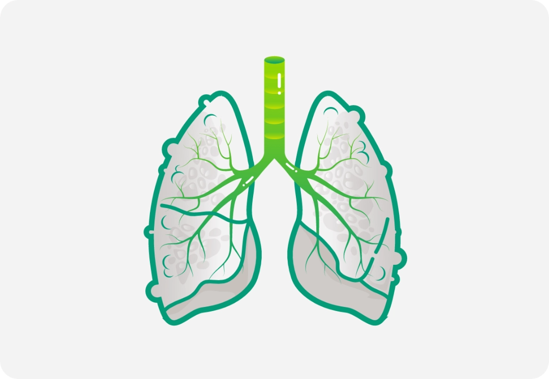 Illustration of two hands with nodules representing prurigo nodularis. 
