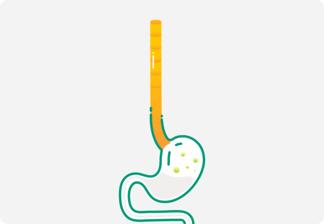 Illustration of a human digestive track to stomach representing eosinophilic esophagitis.
