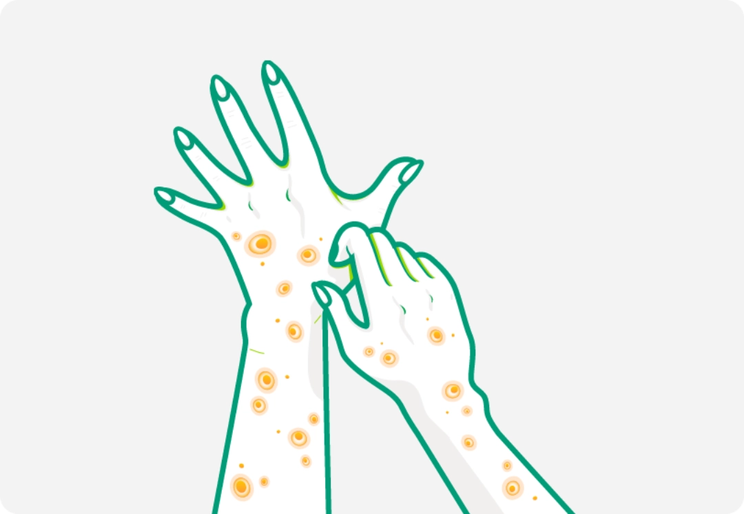 Illustration of two hands with nodules representing prurigo nodularis.