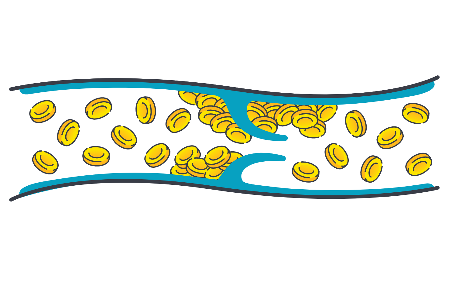 Illustration of a blood vessel showing red blood cells and a yellow clot representing thrombosis.          
