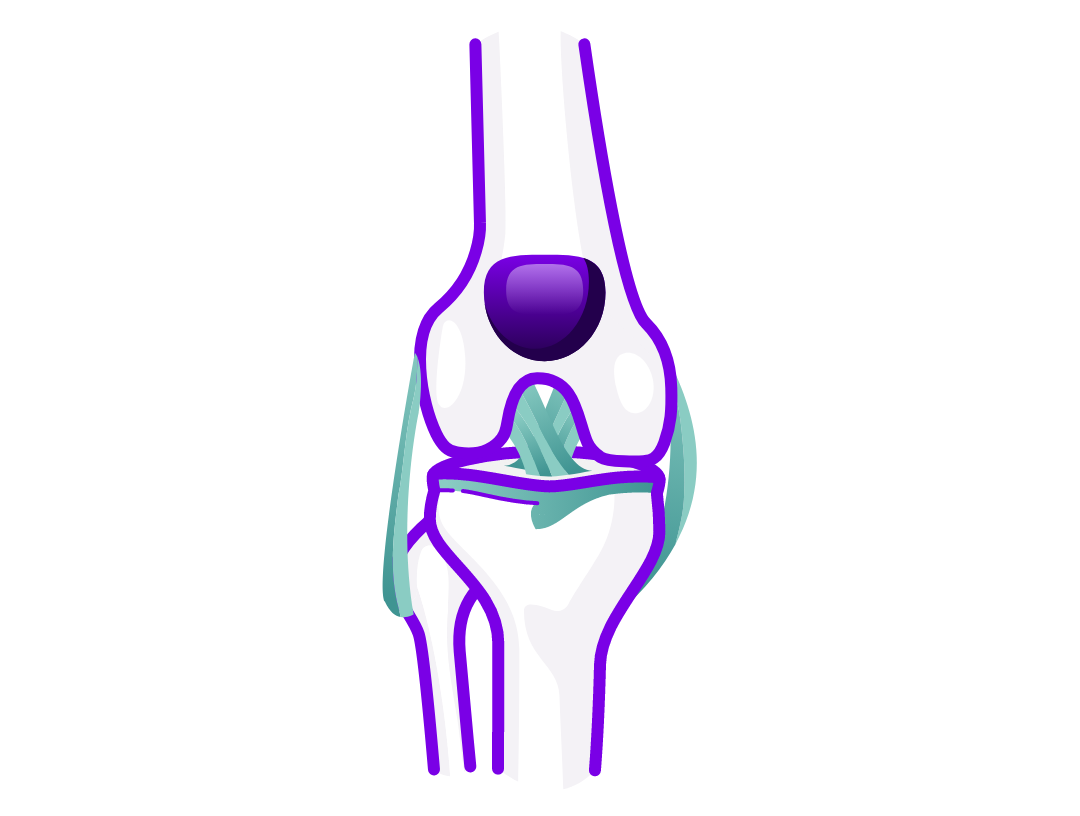 Illustration of a knee joint, showing damage from rheumatoid arthritis. 
