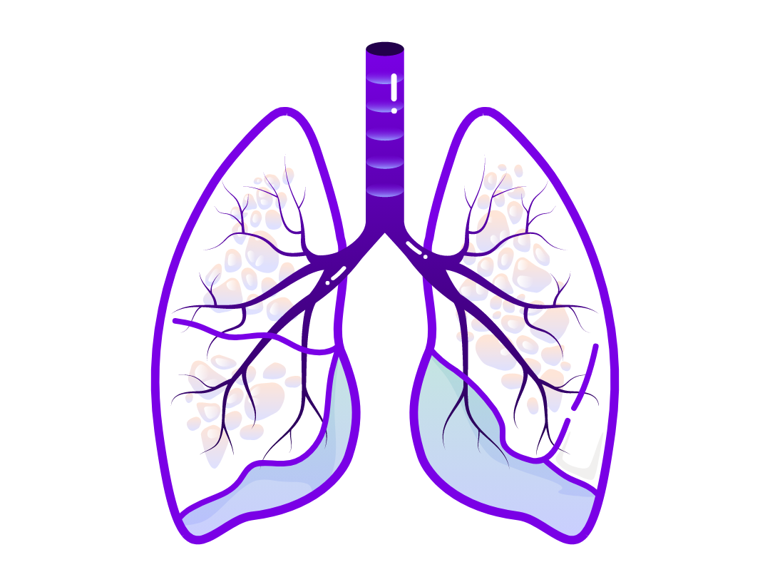 Illustration of a lung showing narrowed airways typical in asthma. 