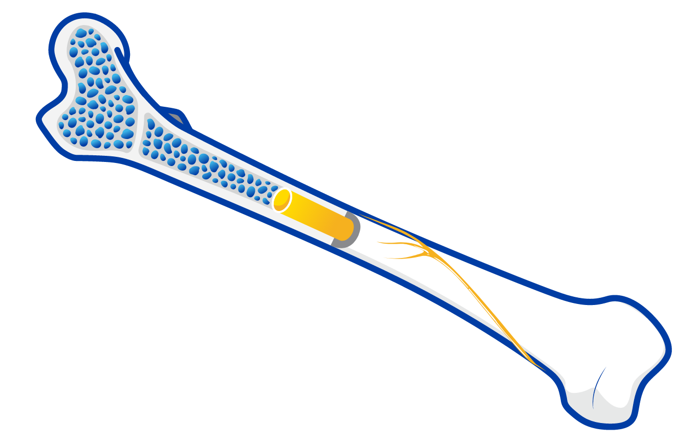 Illustration of a human bone to demonstrate skeletal involvement.