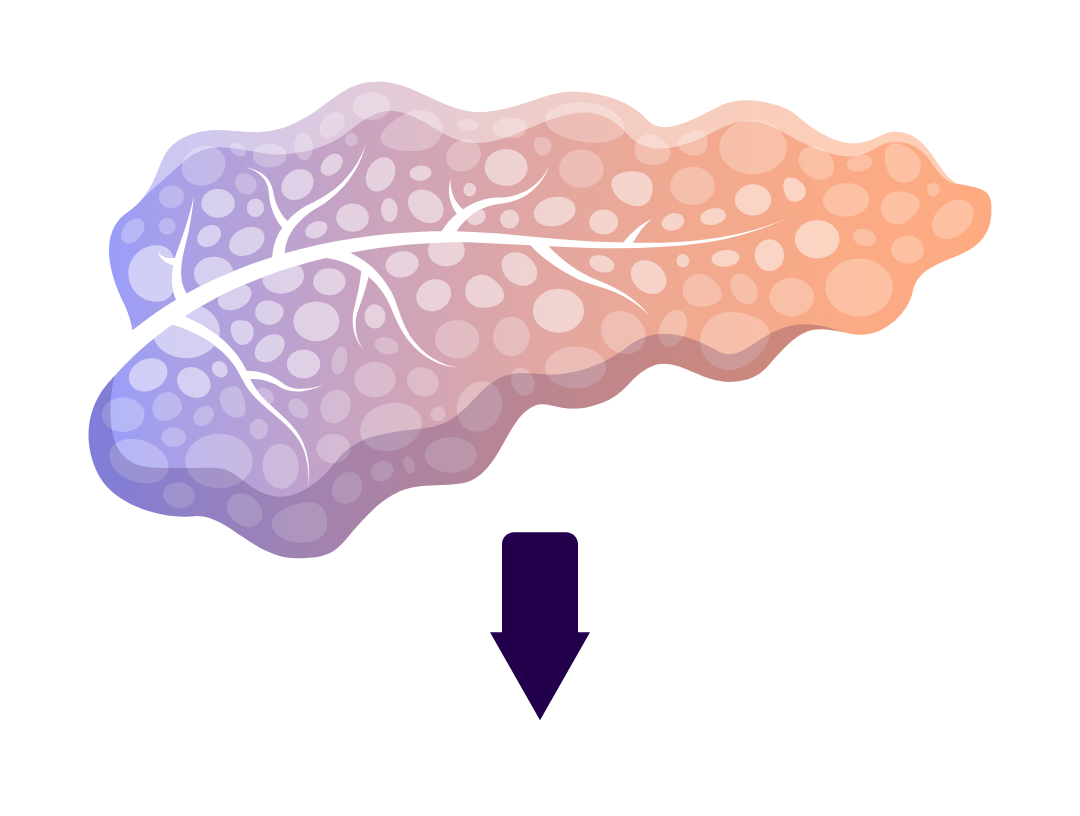 Illustration of a human pancreas and crossed out dollar bill representing prevention of DKA-related costs.   
