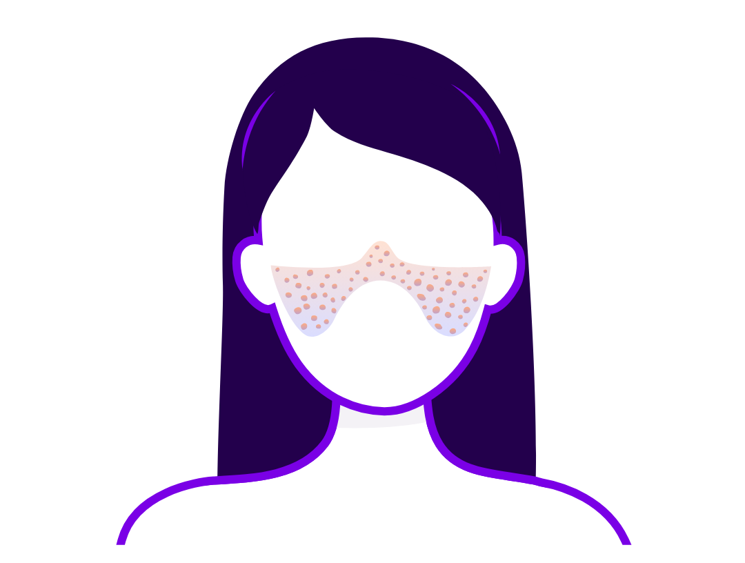 Illustration of a woman with butterfly-shaped rash, characteristic of lupus. 