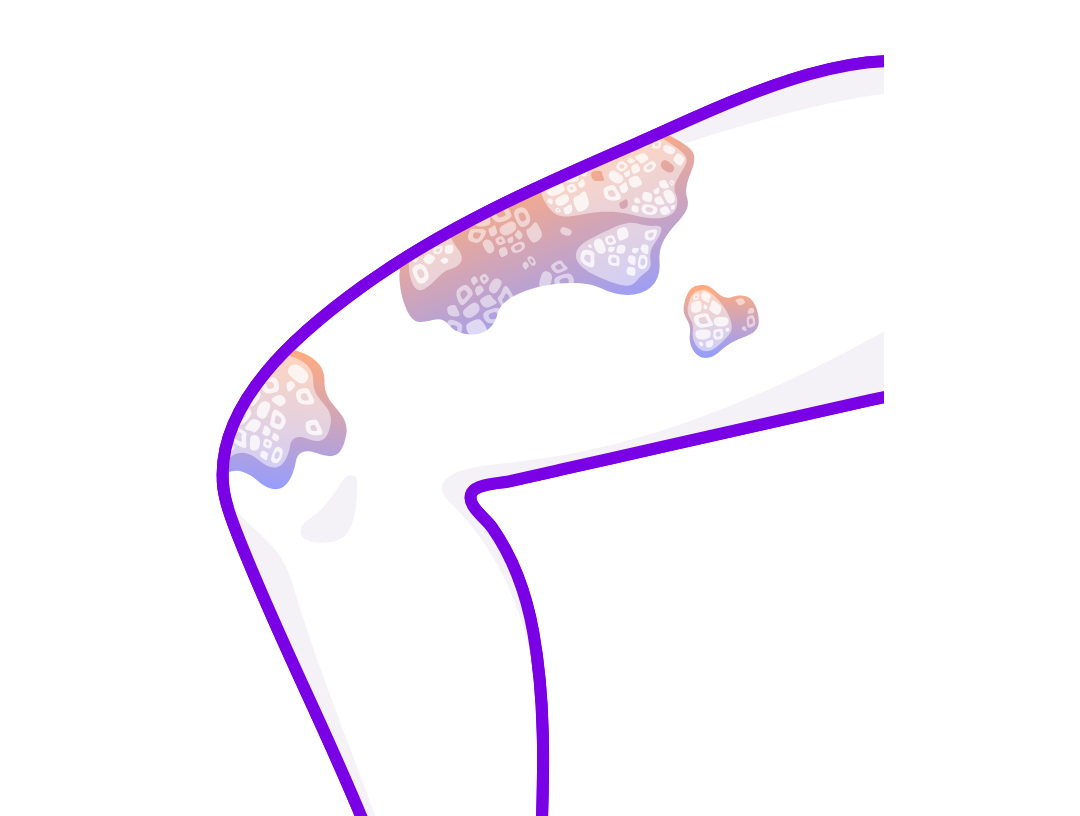 Illustration of an arm showing red, scaly skin affected by psoriasis. 