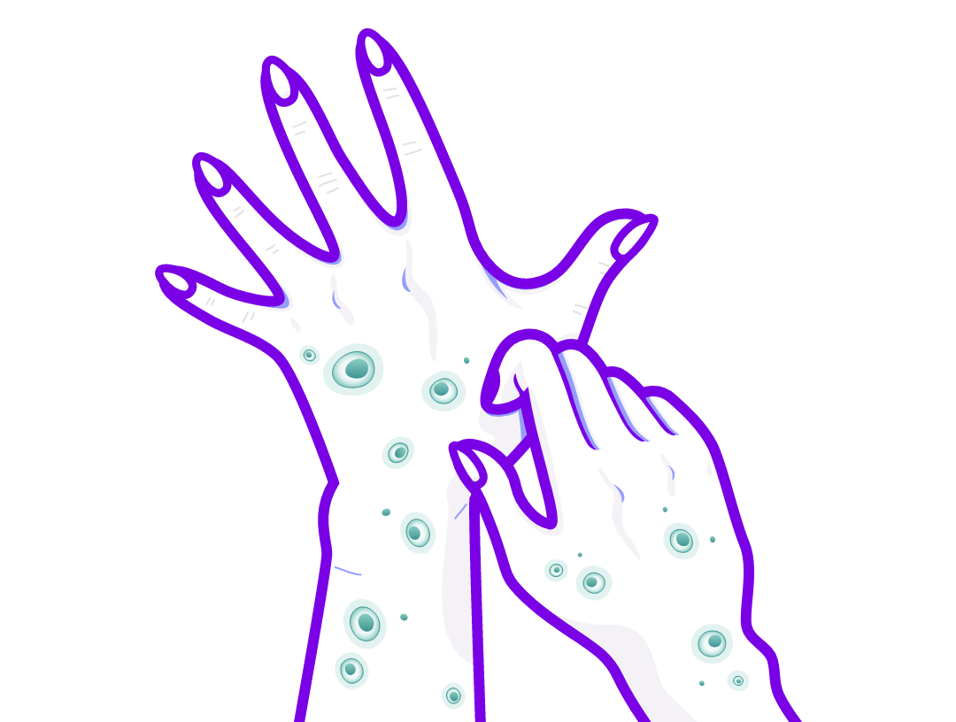 Illustration of a unexplained chronic itching (CPUO) affecting the skin. 
