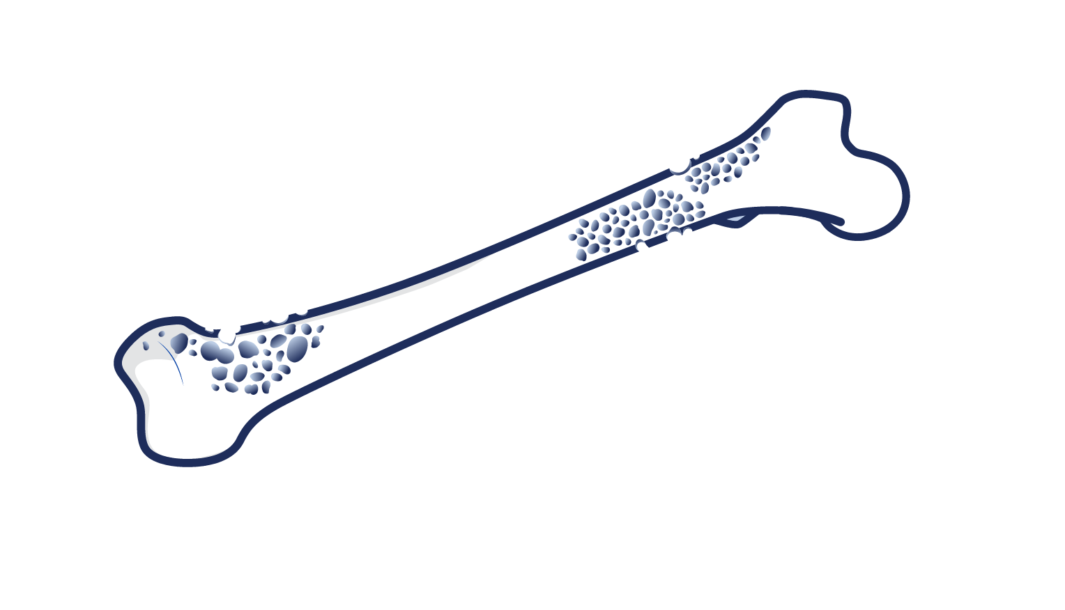 Icon representing severe skeletal-related events (SREs).