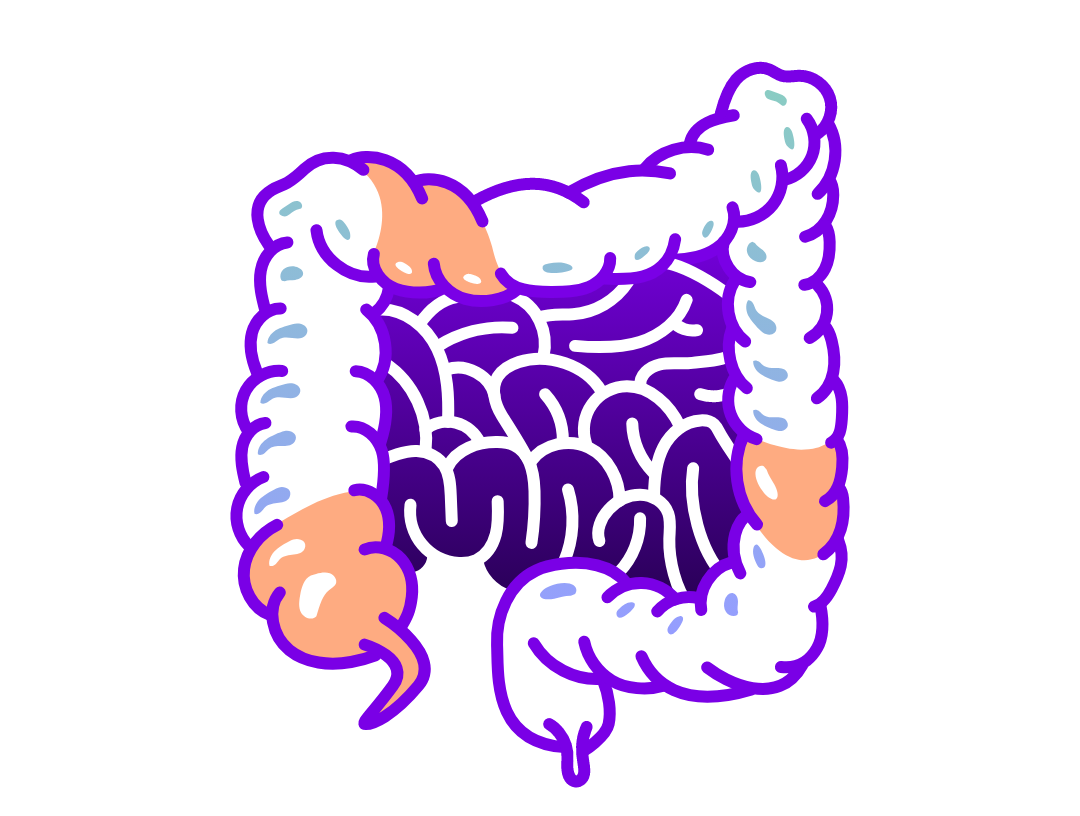 Illustration of digestive tract with patchy inflammation showing Crohn’s disease.  