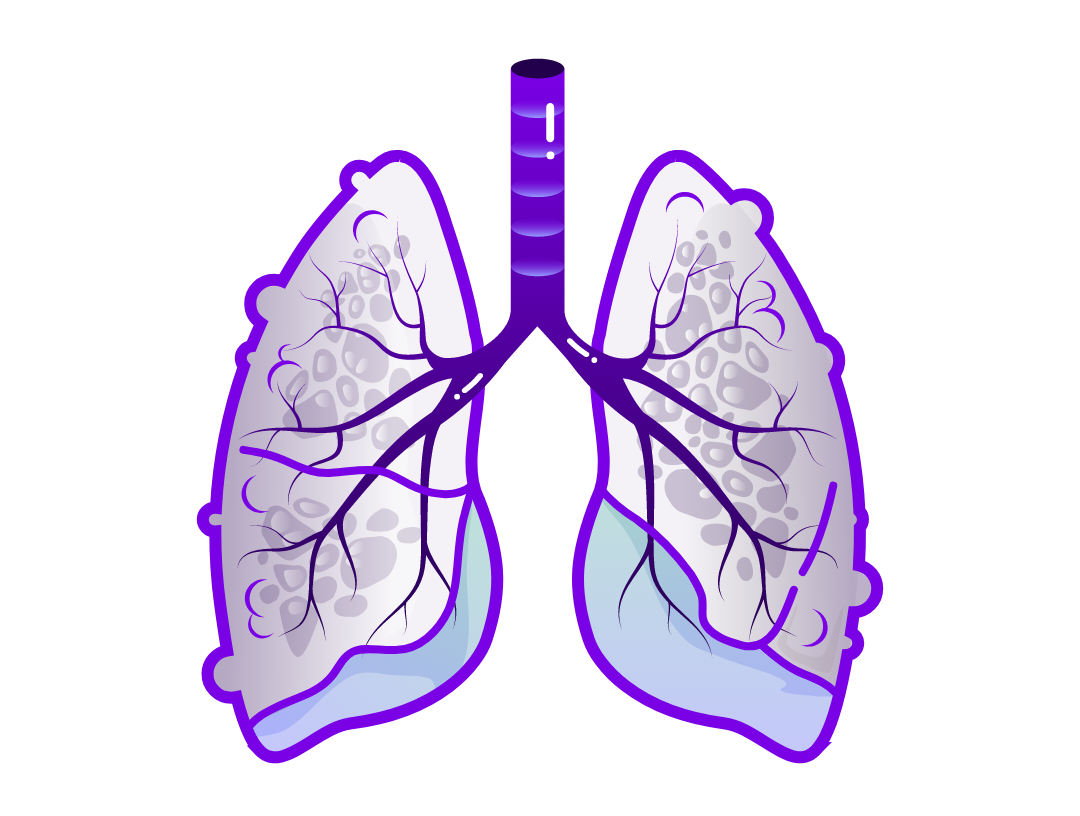 Illustration showing damaged lungs and airflow limitation in COPD. 