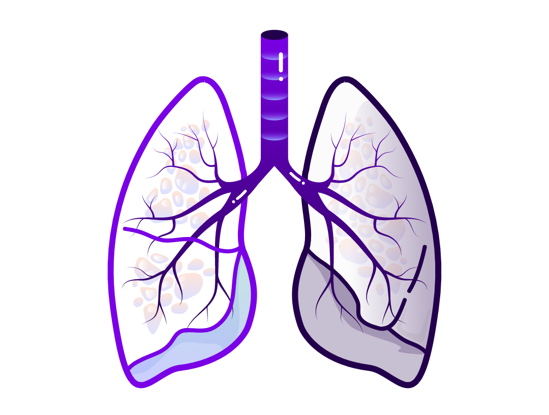 Illustration of a lung representing allograft rejection. 