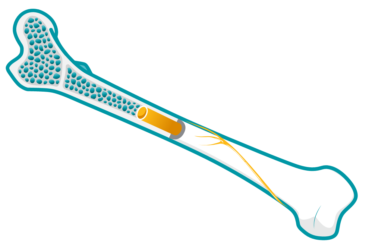 Illustration of a human bone to demonstrate skeletal involvement. 