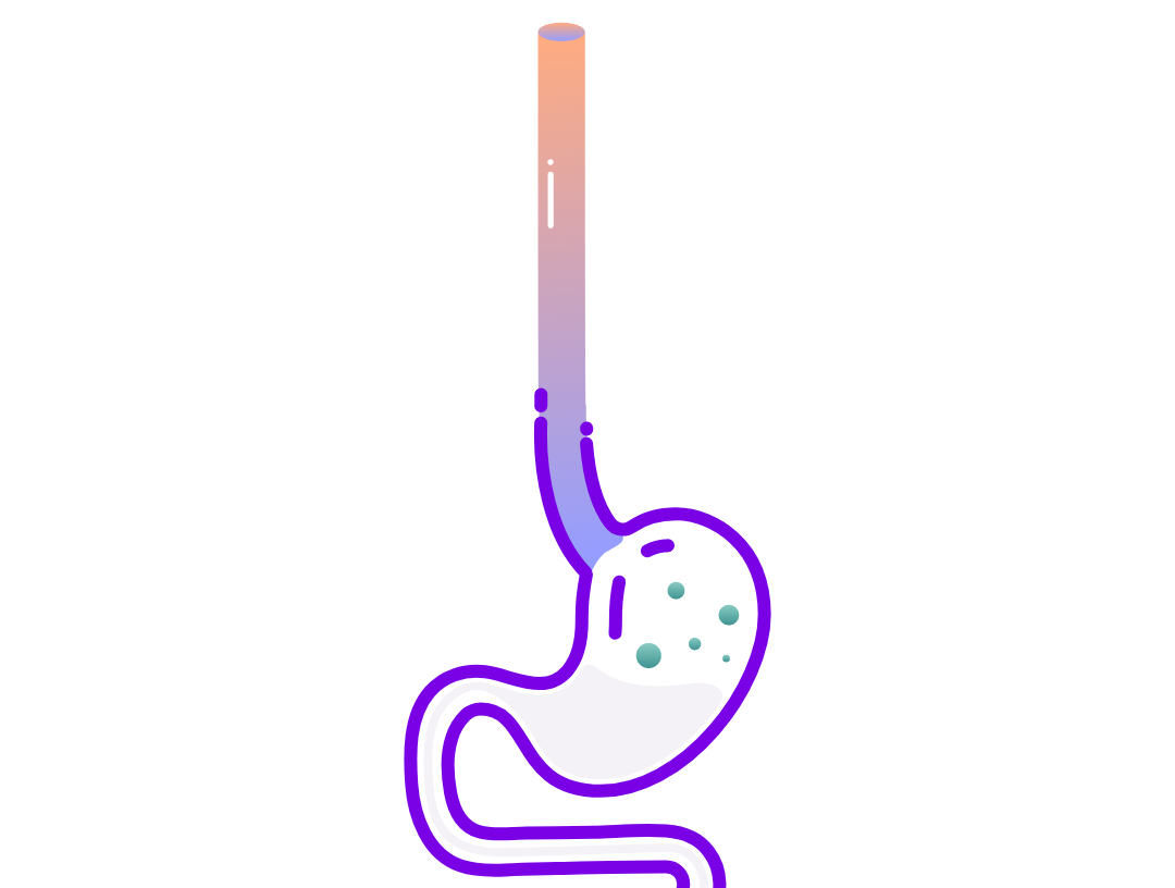 Illustration of stomach diagram indicating eosinophilic inflammation. 