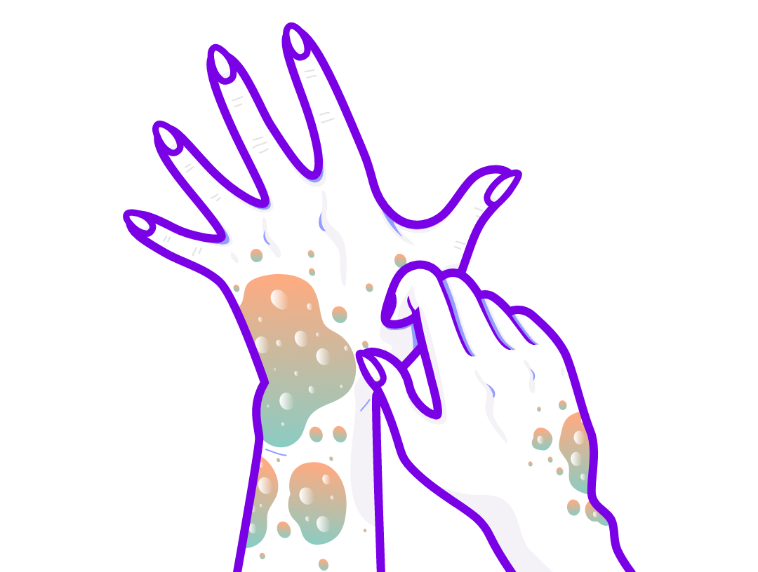 Illustration of hands with visible symptoms of atopic dermatitis. 