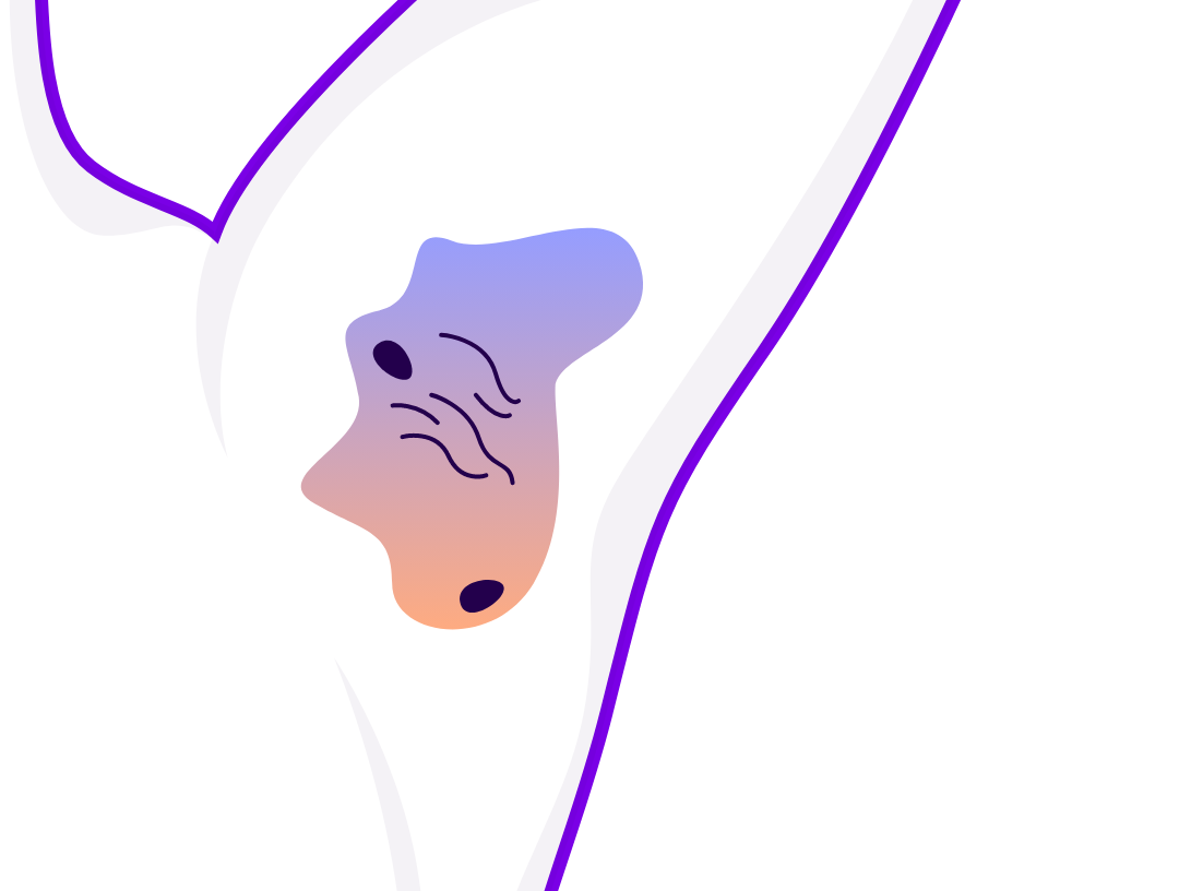 Illustration of inflamed skin lesions in the armpit typical of hidradenitis suppurativa. 