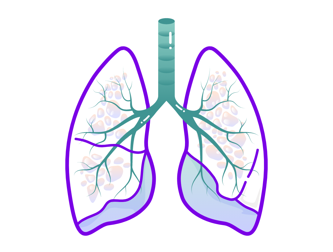 Illustration of dilated airways representing bronchiectasis. 