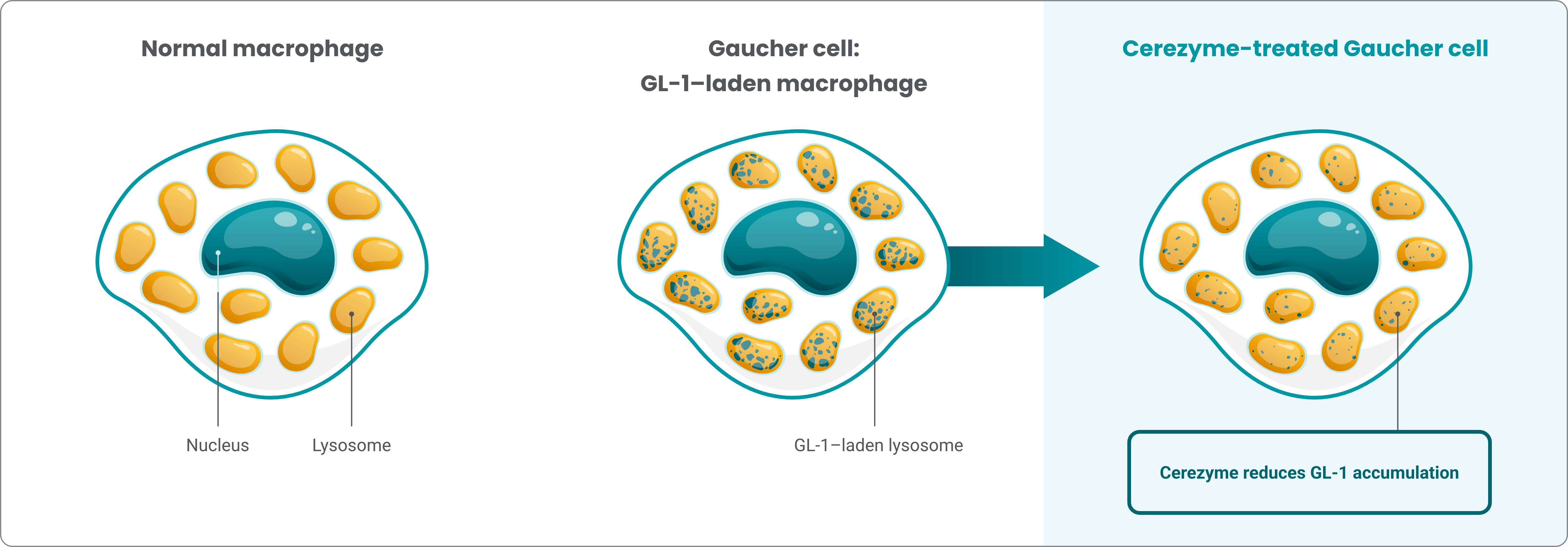 Illustration comparing Cerezyme treated Gaucher Cells to non-treated Gaucher Cells and normal macrophage. 
