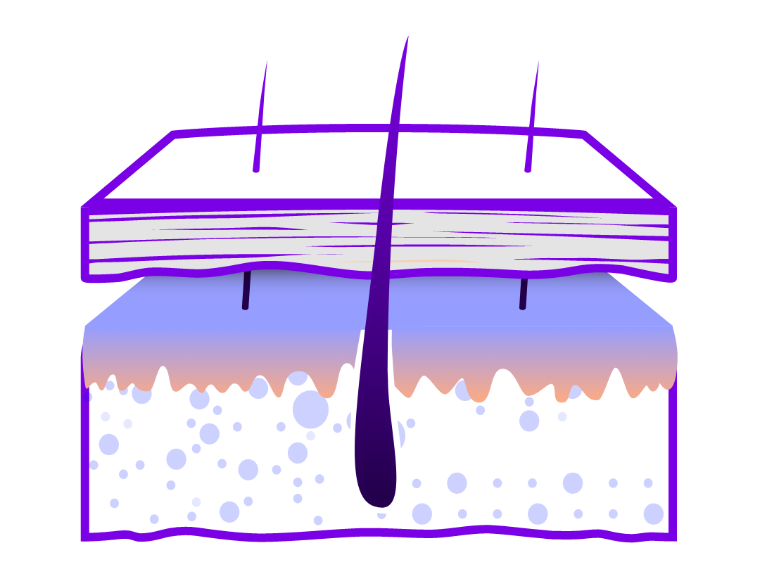 Illustration of a cross-section of skin showing hair loss due to alopecia. 