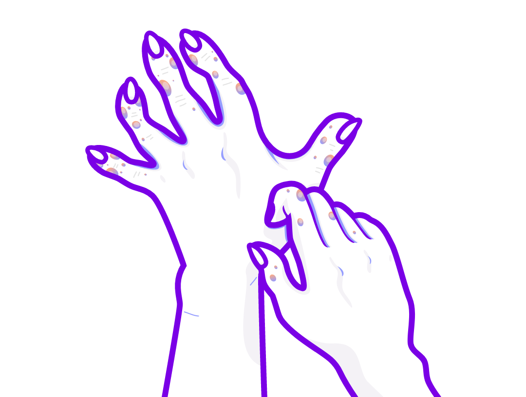 Illustration of stiff, thickened skin on arms, indicative of scleroderma. 