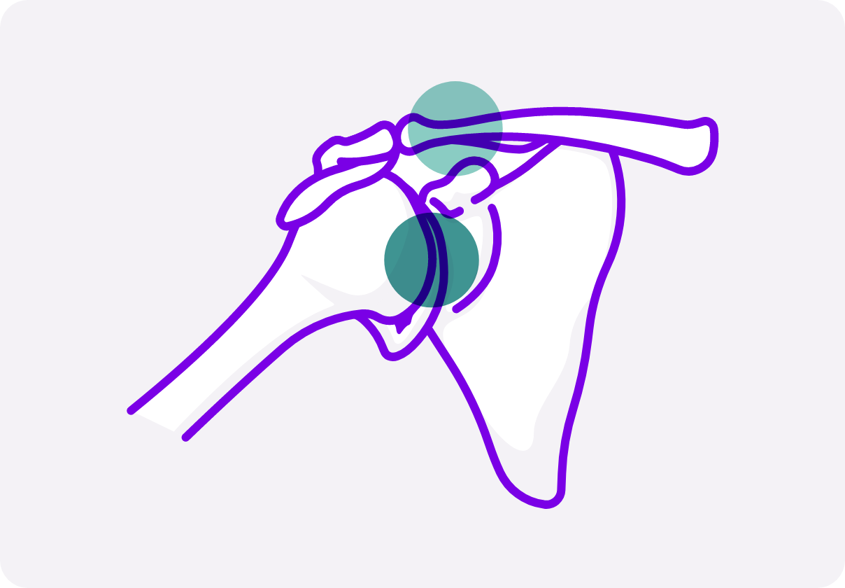 Illustration of inflammation around the shoulder joint. 
