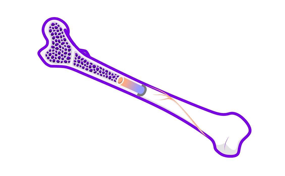 Illustration representing bone manifestations. 